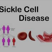 Sickle Cell Disease Pathophysiology Symptoms And Treatment