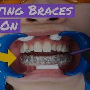 Process Of Getting Braces