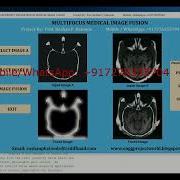 Multifocus Image Fusion Using Matlab Source Code Multifocus Medical Image Fusion Source Code