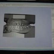Digital Orthodontic Study Models Part 1 Hollowing Out