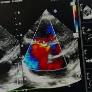 Isolated Gerbode Defect