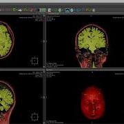 Marked Watershed Segmentation MRI Brain Tissue Segmentation
