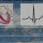 Фактор внезапной смерти укороченный интервал P Q Воробьев Л В