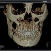 3D Ceph Module Superimposition