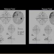 Lecture Advanced Perimetry Interpretation Recognizing And Dealing With Artifacts