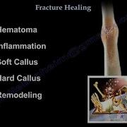 Fracture Healing Everything You Need To Know Dr Nabil Ebraheim