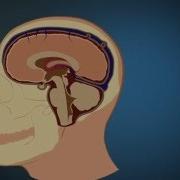 Subdural Hematoma