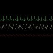Simulated Patient Monitor Waveforms