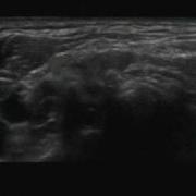 Ultrasound Guided Superficial Cervical Plexus Block With A HFL50 Probe