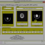 Medical Image Fusion On DICOM Images Using Wavelet Transform And PCA Full Matlab Source Code