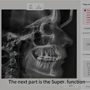 How To Use The CEPH Measurement Tool