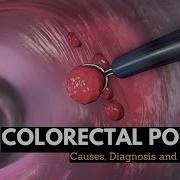 Colorectal Polyps Causes Signs And Symptoms Diagnosis And Treatment