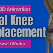 Total Knee Replacement See How It Works