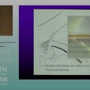 Open Angle Glaucoma ARCHIVE