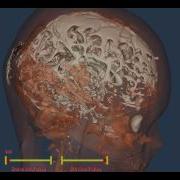 VTK Brain Reconstruction