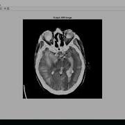A Fast Fractal Based Compression For MRI Images