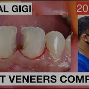 Step By Step Direct Veneers Composite Anterior Multiple Cases 20mins General Dentist Griya RR