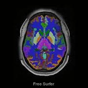 Meshnet Vs FreeSurfer Side By Side Example