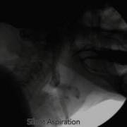 Normal And Silent Aspiration Swallow
