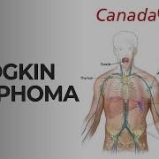 Hodgkin Lymphoma Explained Reed Sternberg Cells Staging Treatment CanadaQBank