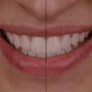 The Concept Of Digital Smile Design And How To Do It Dr Nour Marshaha