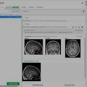 Step 2 Anterior Commissure Posterior Comissure ACPC Alignment