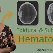 CT Imaging For Epidural Hematoma What You Need To Know