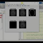 Brain Tumor Detection Using Image Processing Matlab Project Source Code