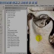 Tx STUDIO 3D Analysis Cephalometric Tracing