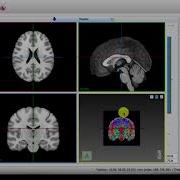 MI Brain 2D 3D Views Layout