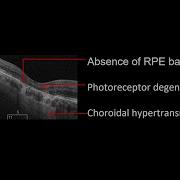 New Lexicon In Dry AMD Part 1 CRORA