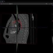 Vessel Centerline Calculation