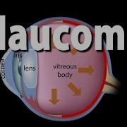 Development Of Glaucoma Animation Open Angle Vs Angle Closure Glaucoma