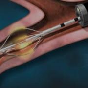 Asthma Animation