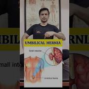 Best Exercise For Umbilical Hernia Relief Shorts Tranding