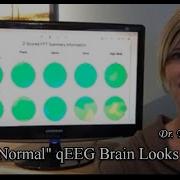 What A Normal QEEG Brain Map Looks Like