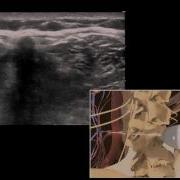 How To Ultrasound Guided Lumbar Puncture Procedure 3D Video