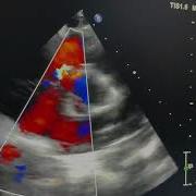 Gerbode Defect Isolated