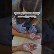 Botox For Your Hands Shorts Botox Sweat