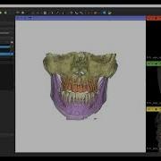 3D Slicer Instance Segmentation Plugin For Individual Teeth