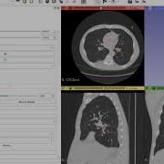 Finding Shortest Path Between Two Points In The Bronchial Tree