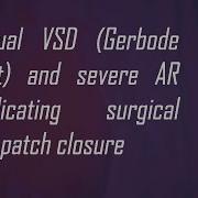 Residual VSD Gerbode Defect And Severe AR Complicating Surgical VSD Patch Closure