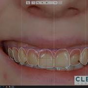 Mock Up Part 1 Digital Smile Design 3Shape Trios