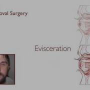 Eye Removal Surgeries