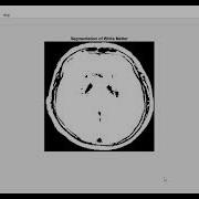 MRI SEGMENTATION OF THE HUMAN BRAIN USING MULTI RESOLUTION EDGE DETECTION AND REGION GROWING