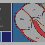 Gerbode Defect