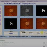 Diabetic Retinopathy Detection Using Image Processing Full Matlab Project Code