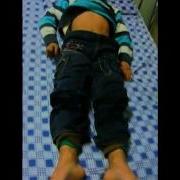 Boy With Sydenham S Chorea NEJM