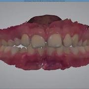 3DBioCAD 3Shape Ortho Analyzer How To Perform A KIG