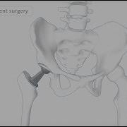 How A Hip Replacement Is Performed Spire Healthcare